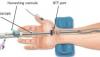 Photo for Endoscopic Vessel Harvesting System Market Report From 2018 To 2025 Analysis By Top Company Profiles - CARDIO MEDICAL GmbH, LivaNova plc. (Sorin and Cyberonics), MAQUET Holding B.V. & Co. KG