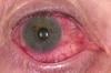 Photo for Global Conjunctivitis Market Manufacturers Sales Analysis Report 2019-2024