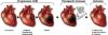 Photo for Myocardial Infarction Therapeutics Market Report 2018-2025 By Top Players - Novartis N.V., Daiichi Sankyo Company Limited, Bristol-Myers Squibb Company, Boehringer Ingelheim GmbH