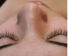 Photo for Permanent Solution for Facial Hair Removal