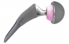 Photo for Global Hydroxyapatite-coated Femoral Components Market 2019 | Manufacturers, Regions, Type And Application, Forecast To 2024
