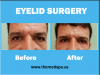 Photo for Eyelid Surgery in Delhi, India at MedSpa