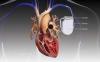 Photo for Cardiac Implants Market Share, Applications, Growth Trends, Key Players
