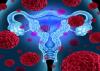 Photo for Ovarian Cancer Drugs Market Pipeline Analysis 2018