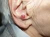 Photo for Merkel Cell Carcinoma Market 2019 | Growth Factors, Global Industry Analysis, Key Players, Regional Trends and Emerging Technologies with forecast till 2023