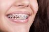 Photo for Watch Your Gums If You Wear Braces