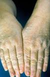 Photo for Cowden Syndrome Market 2019 | Business Growth, Industrial Outlook, Global Key Players with Forecast till 2023
