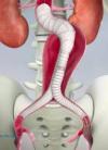 Photo for Aortic Stent Grafts Market 2019: Industry Growth, Trends and Research Report, To 2025