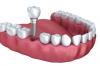 Photo for Dental Implants Costs - What You Need to Know