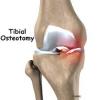 Photo for Osteotomy Plates Market 2019 Top Comapny Profiles with Forecast Till 2024