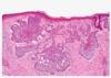 Photo for Skin cancer procedure