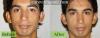 Photo for Natural Vitiligo Treatment