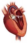 Photo for Transcatheter Aortic Valve Replacement (TAVR) Market 2019 Top Comapny Profiles with Forecast Till 2024
