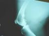 Photo for Osteosarcoma Market Market: Boosting the Healthcare Industry Worldwide 2018-2025