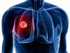 Photo for Comprehensive Study Reveals that How Lung Cancer Screening Software Market is Trending
