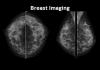 Photo for Breast Imaging Market 2017 Top Comapny Profiles with Forecast Till 2022