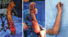 Photo for Extremity Reconstruction Market To, 2026 Research Report - Acumed LLC, Arthrex, INC., CONMED Corporation, Integra Lifesciences Holdings Corporation