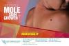 Photo for Moles Akron - Mayfield Heights - Mentor OH - Nevis - Skin Pigmentation