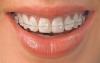 Photo for Orthodontic Consumables Market Analysis, Industry Size, Share And New Opportunities Till 2024