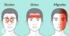 Photo for migraine headaches