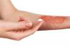 Photo for Global Burn Care Products Market 2019 | Manufacturers, Regions, Type and Application, Forecast to 2024