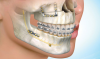 Photo for Craniomaxillofacial Devices Market Strong Demand Analysis, Industry Size  And Forecast 2026