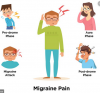 Photo for Migraine Postdrome Treatment