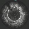 Photo for Intravascular Ultrasound Market Size Is Expected To Cross USD 3.53 Billion By 2025
