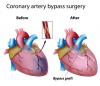 Photo for Coronary Artery Bypass Graft Market To Make Great Impact In Near Future by 2025