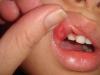 Photo for Mouth Ulcers Treatment Market - Global Industry Analysis, Size, Share, Growth, Trends and Forecast 2014 - 2020