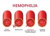 Photo for Hemophilia Market Size Worth $16.9 Billion By 2026