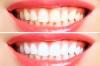 Photo for Whitening Market 2020: Industry Growth, Trends and Research Report, To 2025
