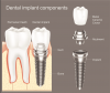 Photo for Osseointegration Implants Market Trends, Drivers, Competitive landscape and Future Opportunities