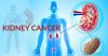 Photo for Kidney Cancer Drugs Market Worth $6.3 Billion By 2022