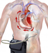 Photo for Global Ventricular Assist Device Market Size, Share, Growth, Trends and Industry Analysis Report, 2019 to 2025