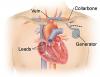 Photo for Global Implantable Cardioverter Defibrillator Market Research Report - Industry Analysis, Size, Share, Growth, Trends and Forecast Till 2026
