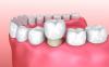 Photo for Order Online Crown Dental Supplies at Clinic