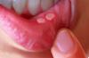 Photo for Global Mouth Ulcer Treatment Drug Market 2020 | Manufacturers, Regions, Type and Application, Forecast to 2025