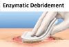 Photo for Global Enzymatic Debridement Market 2020 | Manufacturers, Regions, Type And Application, Forecast To 2025