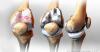 Photo for Small Joint Reconstructive Implants Market and its Growth Prospect in the Near Future