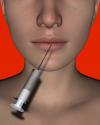 Photo for Facial Implant Market Size, Share, Growth, Trend and Industry Analysis Report, 2022