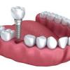 Photo for Know the Latest Study of the Global Dental Implant Market 2020 in the Industry with Prominent Players