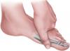 Photo for Global Hallux Rigidus Treatment Market 2020 | Manufacturers, Regions, Type and Application, Forecast to 2025