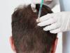 Photo for PRP Hair Treatment in Dubai