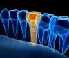 Photo for Dentist in Hanford CA offers Dental Implants