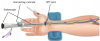 Photo for Endoscopic Vessel Harvesting Systems Market Worth $3.4 Billion By 2025