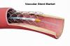 Photo for Global Vascular Stent Market Size, Share, Growth And Forecast To 2023