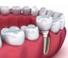 Photo for Dental Implants Hanford CA