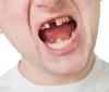 Photo for Dental Implant Procedure Hanford CA