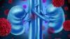 Photo for Global Kidney Cancer Drugs Market 2020 | Manufacturers, Regions, Type and Application, Forecast to 2025
